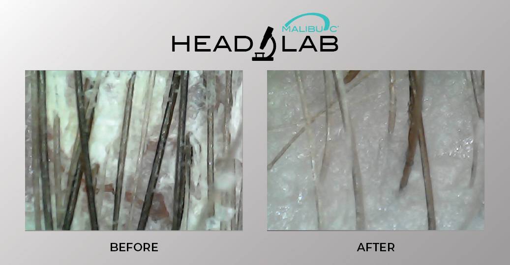 Malibu C Head Lab Before and After Scalp Images