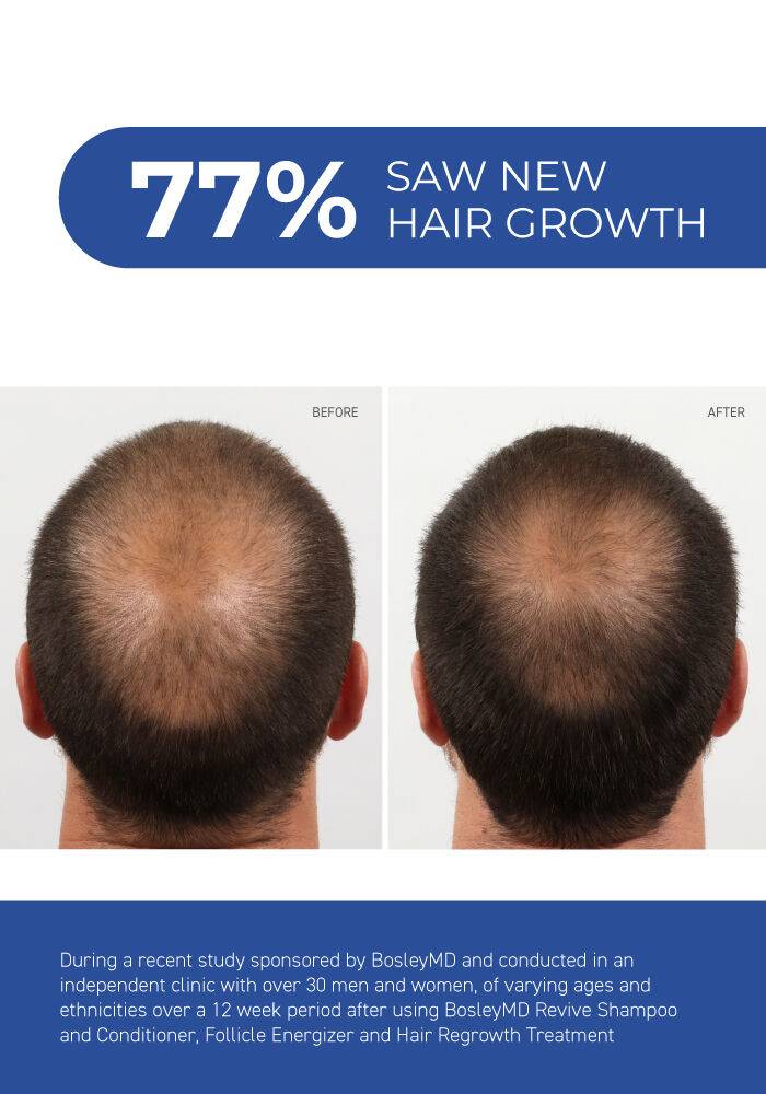 BosleyMD Mens Hair Regrowth Treatment Foam with Minoxidil