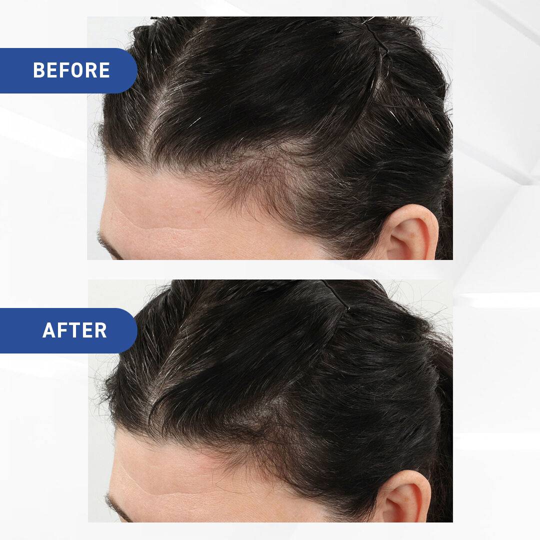 BosleyMD Mens Hair Regrowth Treatment Foam with Minoxidil